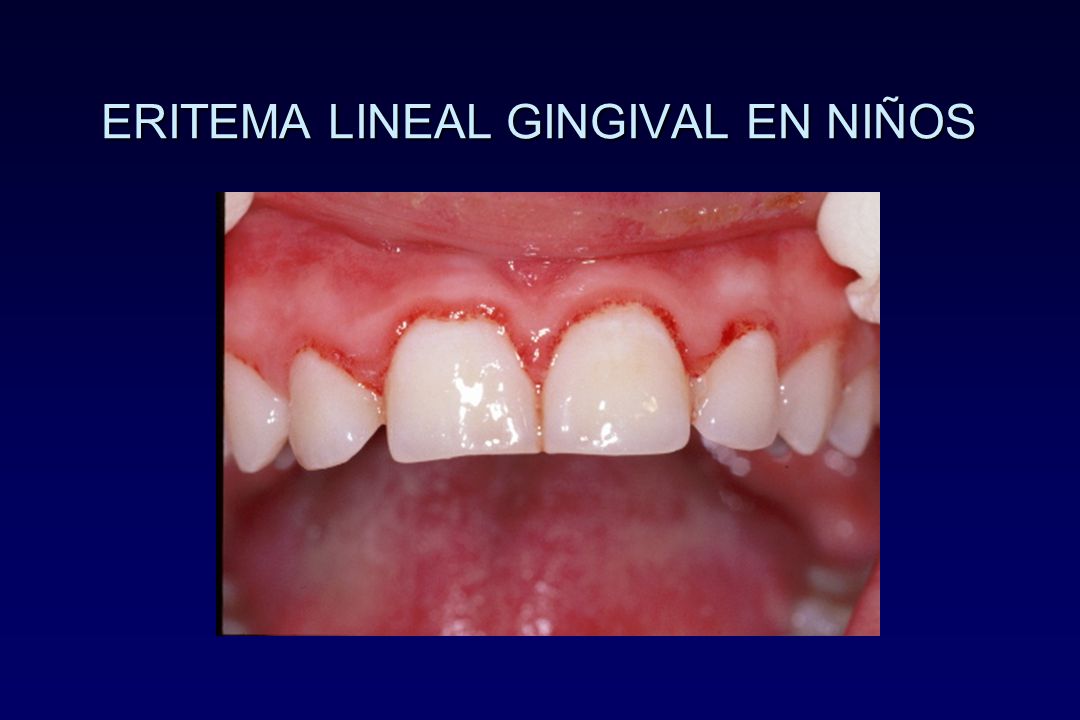 eritema gingival lineal síntomas de diabetes eritema gingival lineal síntomas de diabetes